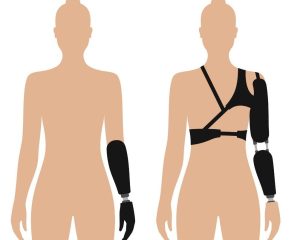 arm_prosthetics
