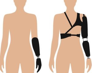 arm_prosthetics